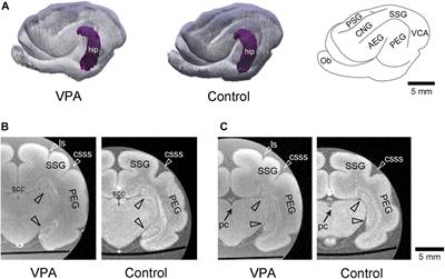 The Proliferation of Dentate Gyrus Progenitors in the Ferret Hippocampus by Neonatal Exposure to Valproic Acid